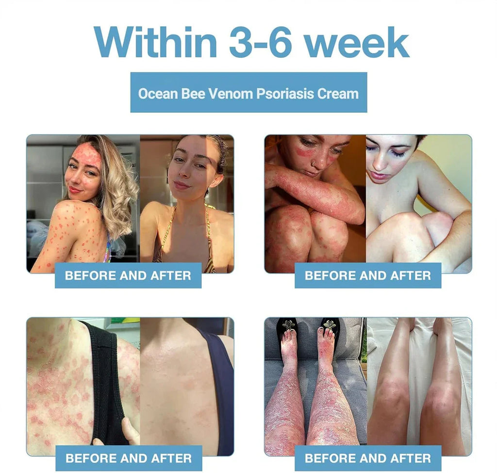 Bee Venom & Ocean Psoriasis Healing Cream
